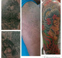 Laserpro Tattoo Removal - e-Seniors